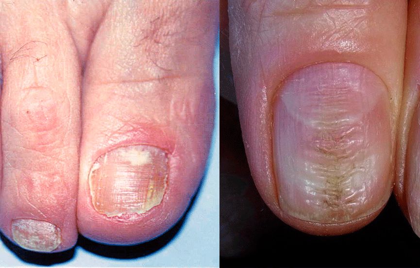 Поперечные полосы на ногтях