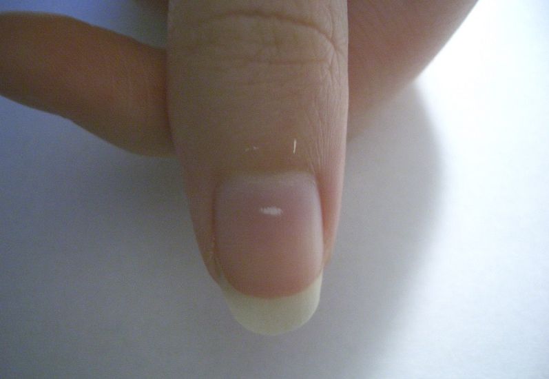 Белые полоски на ногтях