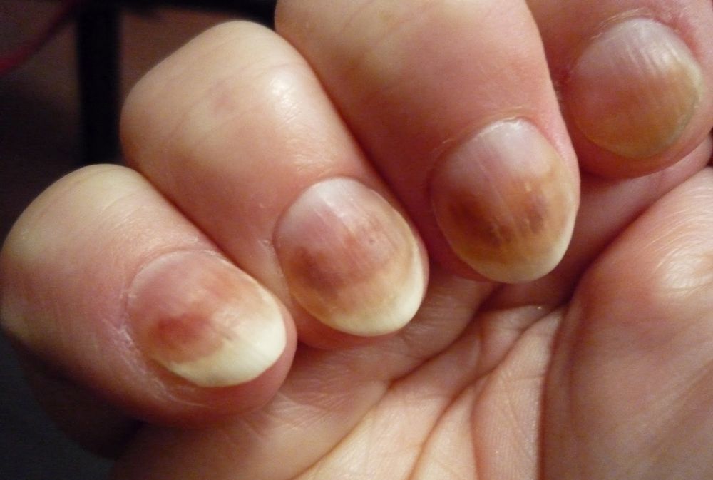 Коричневые полоски на ногтях