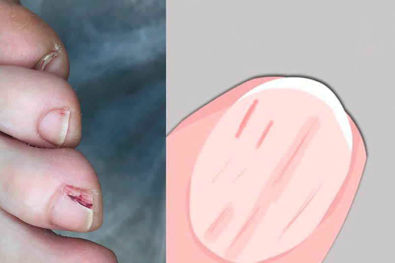 Красные полоски на ногтях